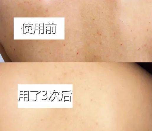 痘痘|背上长痘？神奇“液体”硫磺皂，60秒揪出万千螨虫，李佳琦卖了3万瓶！