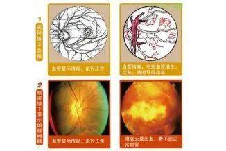 眼底视网膜病变怎么办