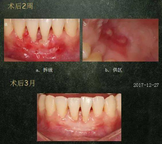 术后三月,术区愈合角化龈宽度均增加至5mm膜龈联合的位置下移基础治疗