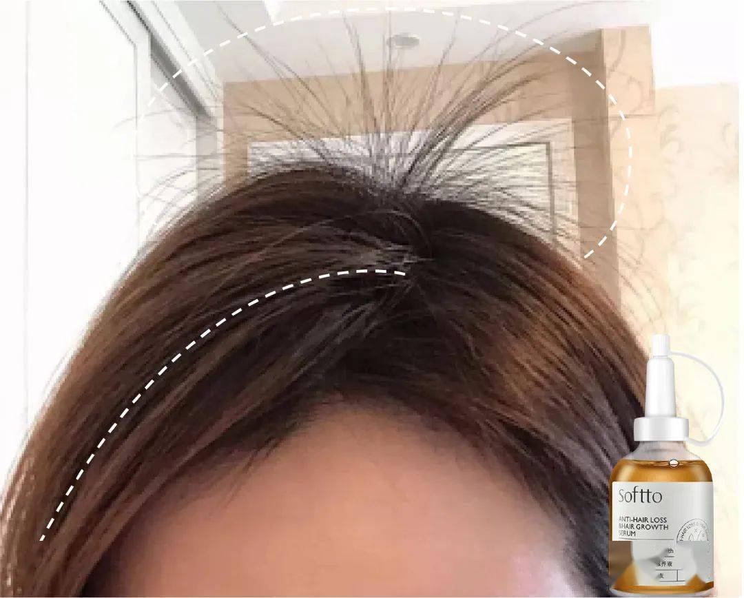 滋养液|32年才做成的育发液!让你挑战30天+生出小绒毛