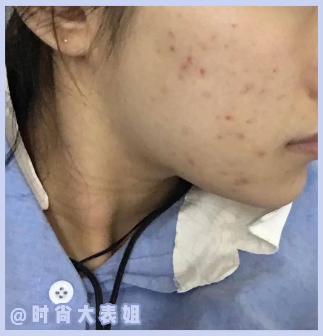 护肤|经常挤痘痘的女生，都是这个下场！（真人实测）
