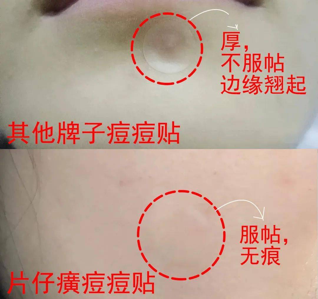 痘痘|“拔”出黄脓，快速消痘！让肌肤变成“白煮蛋”，就是这么简单！