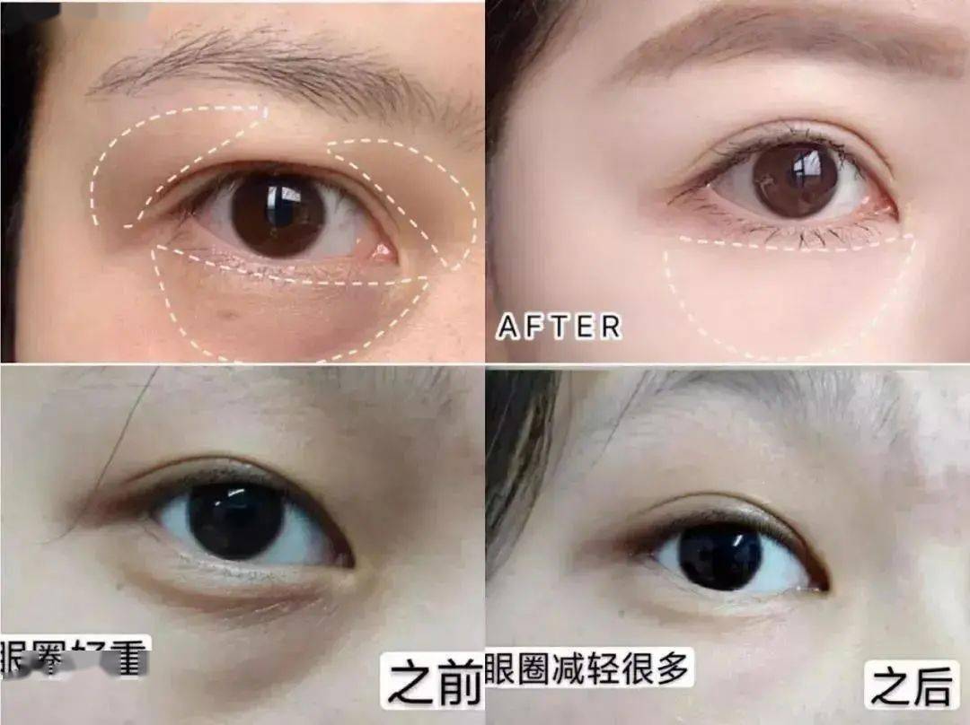 贫民窟|杨幂熬夜后护肤要花2万块？怪不得皮肤吹弹可破！贫民窟女孩就不配消除熬夜痘、黑眼圈吗？