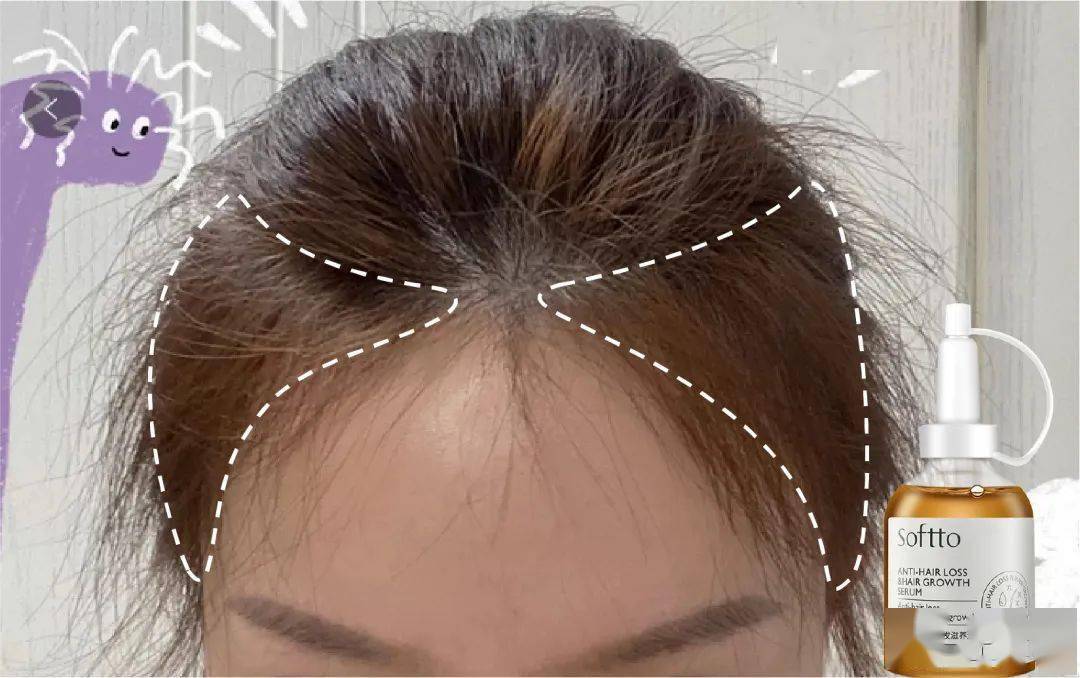 索芙特|原来发际线后移还能这样遮!我终于可以拥有“海藻头”啦