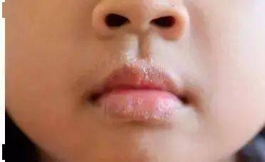 孩子|光喝水就好了吗？最快的方法是这个孩子嘴唇干燥爆皮出血