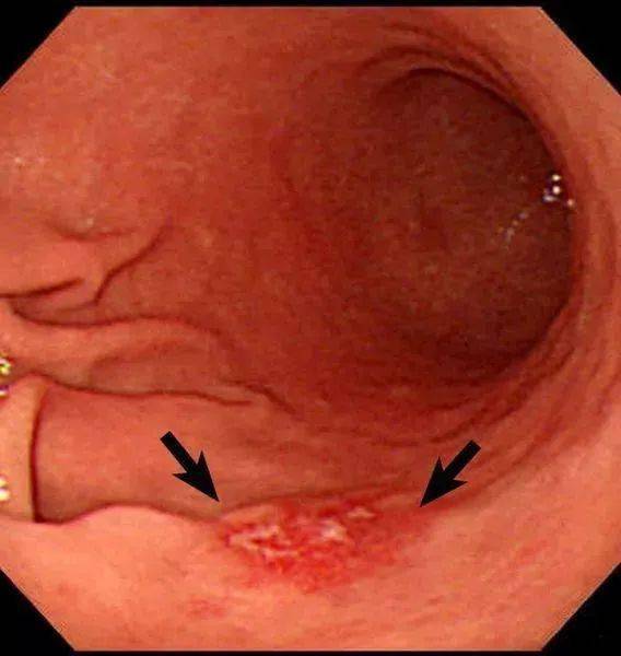 早期胃癌如图所示,很难和胃溃疡分辨开来