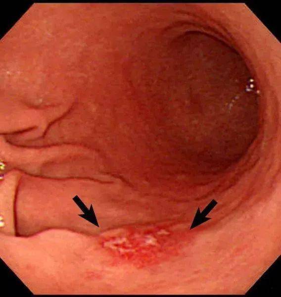 胃体发现不规则糜烂,溃疡时应取活检证实溃疡的良恶性.