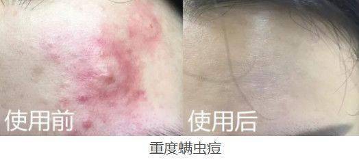 痘痘|夏天变黑长痘不可怕，赶紧用它，让你的皮肤恢复婴儿的光滑，痘痘，黑头，螨虫全都消失了