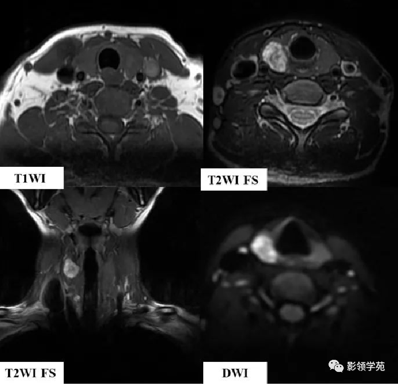 5种常见的甲状腺结节性病变影像表现