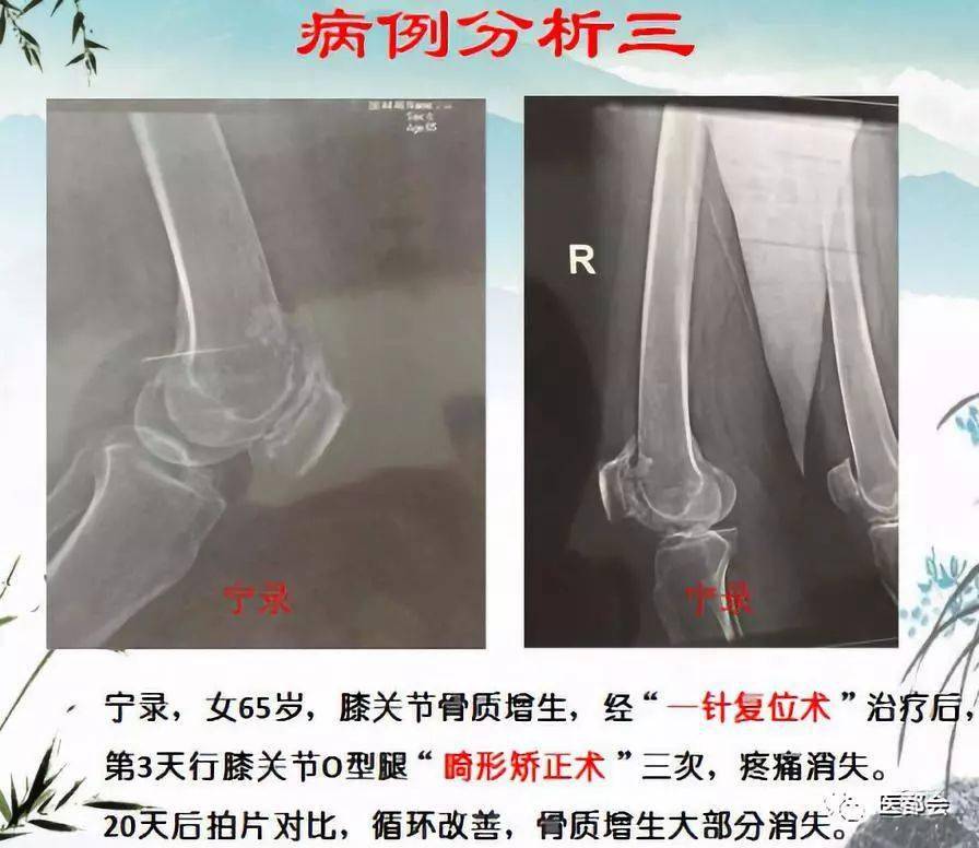 松骨针疗法 暨膝关节畸形一针复位术