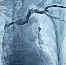 手臂|尿毒症老人求助：透析手臂血管通往心脏的“路”窄了！医生用小小球囊疏通“生命线”