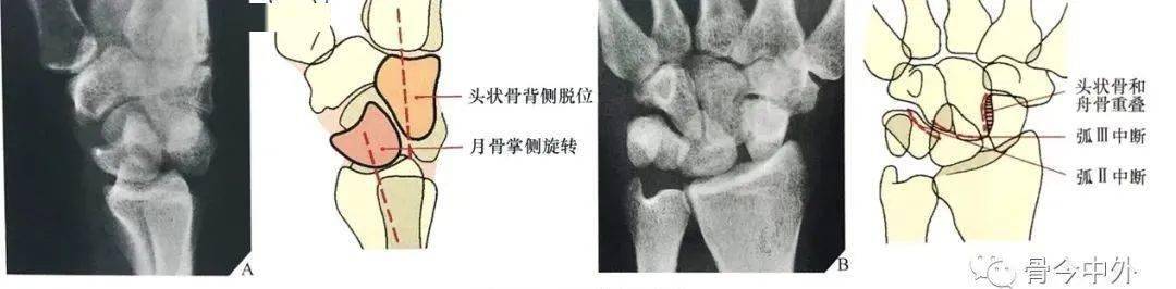 腕关节脱位及其x片阅读技巧