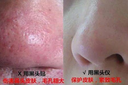 鼻子|米粒大的黑头，瞬间吸出，整个鼻子新生了！