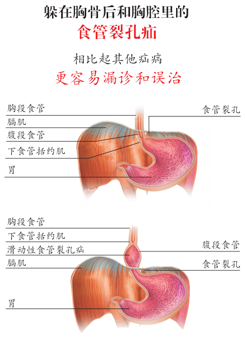 老人反复咳嗽,小便失禁,3年不愈,元凶竟是食管裂孔疝?