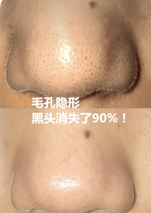 鼻子|米粒大的黑头，瞬间吸出，整个鼻子新生了！