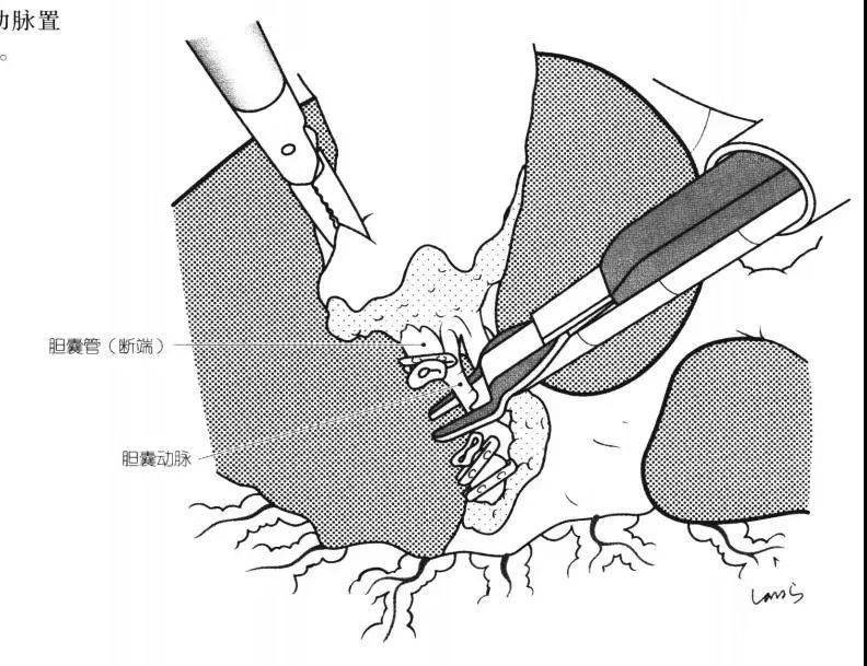 16切断动脉后hartmann氏囊从calot三角解放出来,腹腔镜胆囊切除术可以