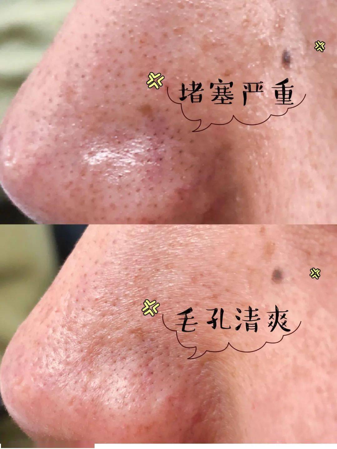 张天|长期闭口、粉刺、痘痘满脸的人，微镜头下毛孔竟然是这样的！赶紧get林允、张天爱的0毛孔秘籍吧！