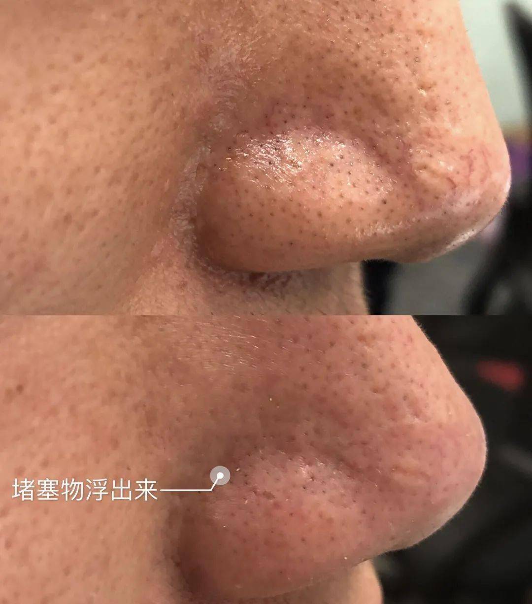 张天|长期闭口、粉刺、痘痘满脸的人，微镜头下毛孔竟然是这样的！赶紧get林允、张天爱的0毛孔秘籍吧！