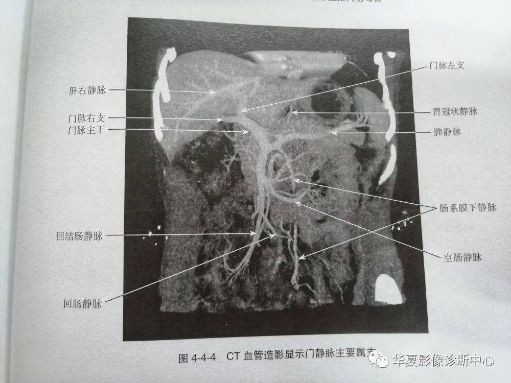 门静脉和上下静脉系之间的吻合支细小,血流量较少,均按照正常方向回流