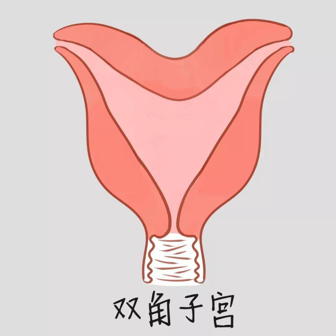 子宫畸形的三种情况，你了解多少？