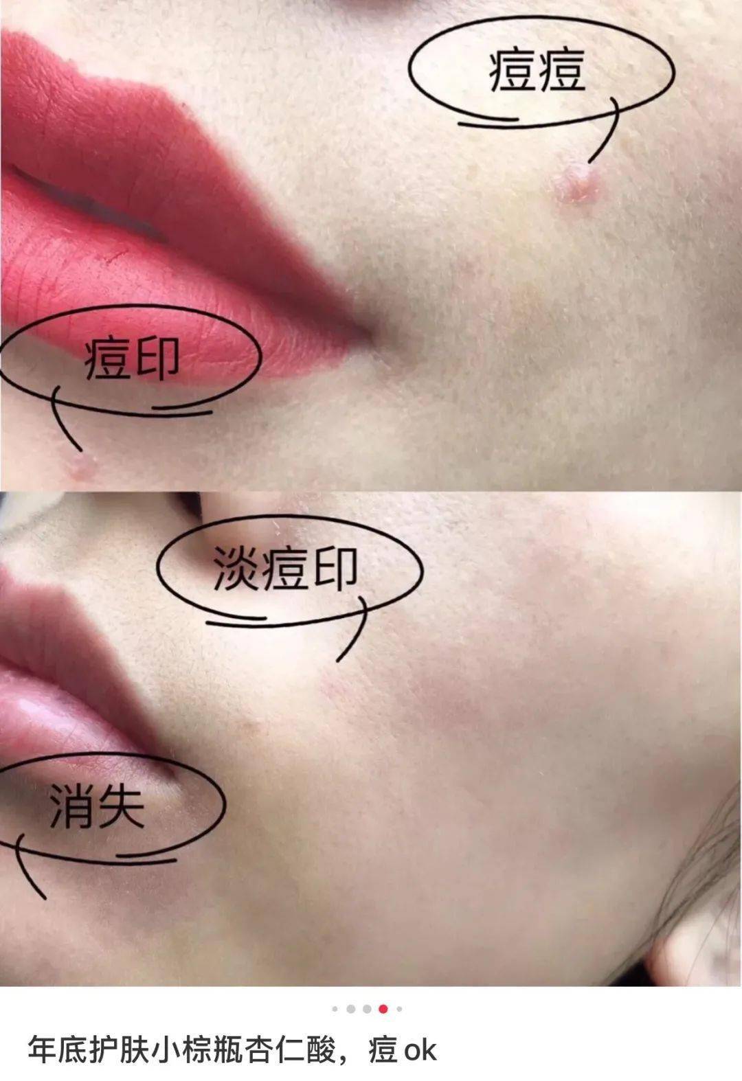 皮肤|刷酸=换脸？这个明星们超爱的百元刷酸好物搞定你的痘痘、闭口、黑头毛孔粗大还不怕烂脸！