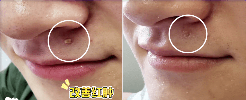 皮肤|刷酸=换脸？这个明星们超爱的百元刷酸好物搞定你的痘痘、闭口、黑头毛孔粗大还不怕烂脸！