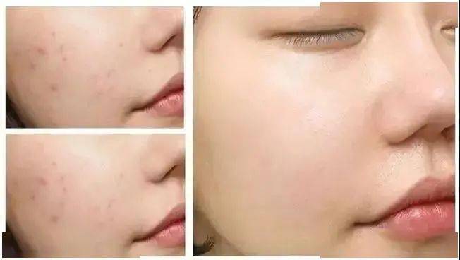 皮肤|刷酸=换脸？这个明星们超爱的百元刷酸好物搞定你的痘痘、闭口、黑头毛孔粗大还不怕烂脸！