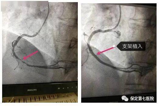 心血管疾病诊治科普知识(一)带您初识冠状动脉造影与支架植入