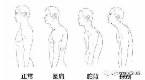 而且出现富贵包的朋友,绝大多数,都会伴随头前伸,颈前引,含胸驼背等