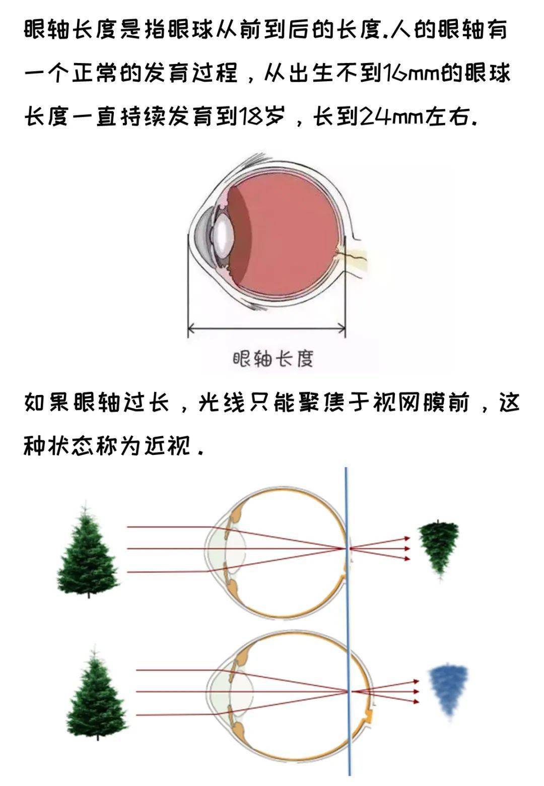 眼轴增长1mm近视增长300度是真的吗