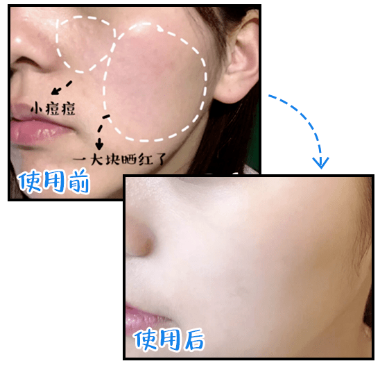 敏飞|数百万敏感肌的心声：皮肤亮红灯真不是我们娇气、玻璃心...