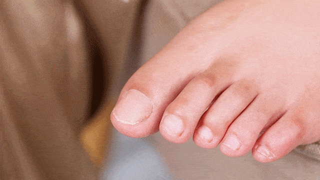 真菌|用“笔”刷一刷，灰指甲竟慢慢变光亮了