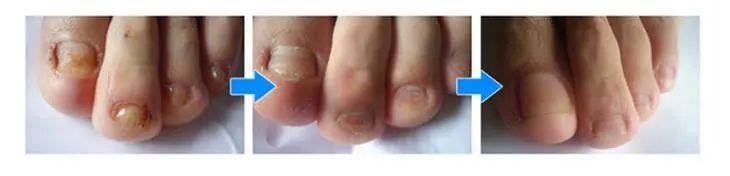 真菌|用“笔”刷一刷，灰指甲竟慢慢变光亮了