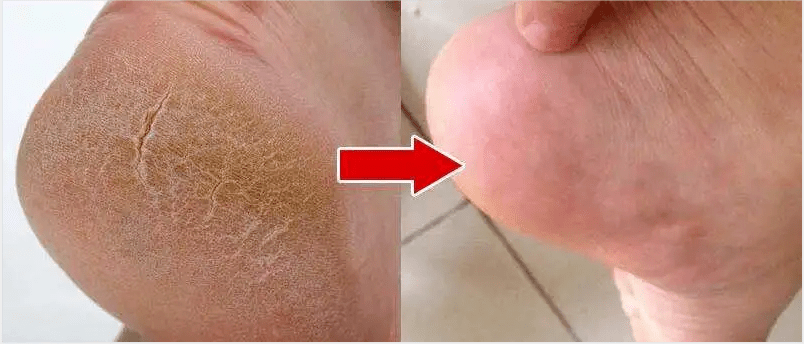 拖鞋|爱穿凉鞋、拖鞋出门的女人,脚上露出这个东西也太丑了吧~