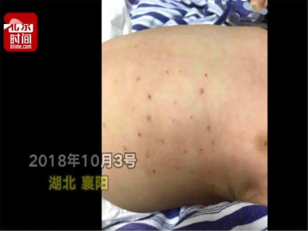 宝宝|爸妈听信偏方，一个决定害死了娃1岁孩子烫伤后