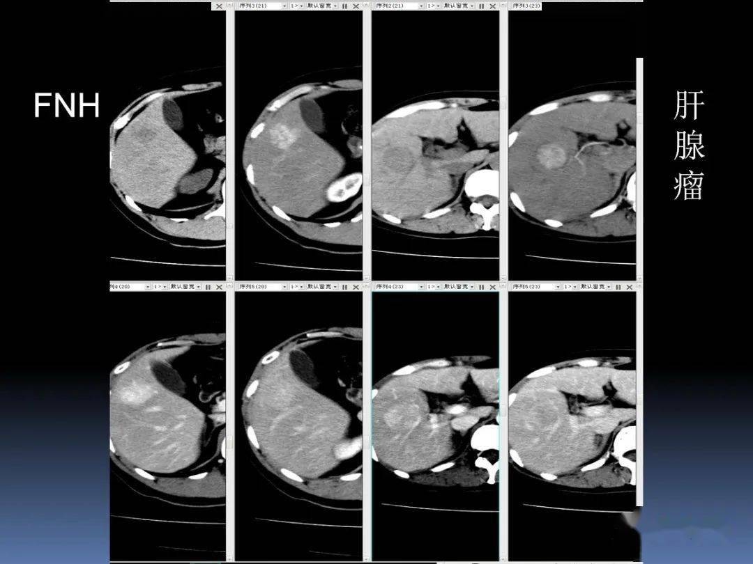 FNH的影像诊断