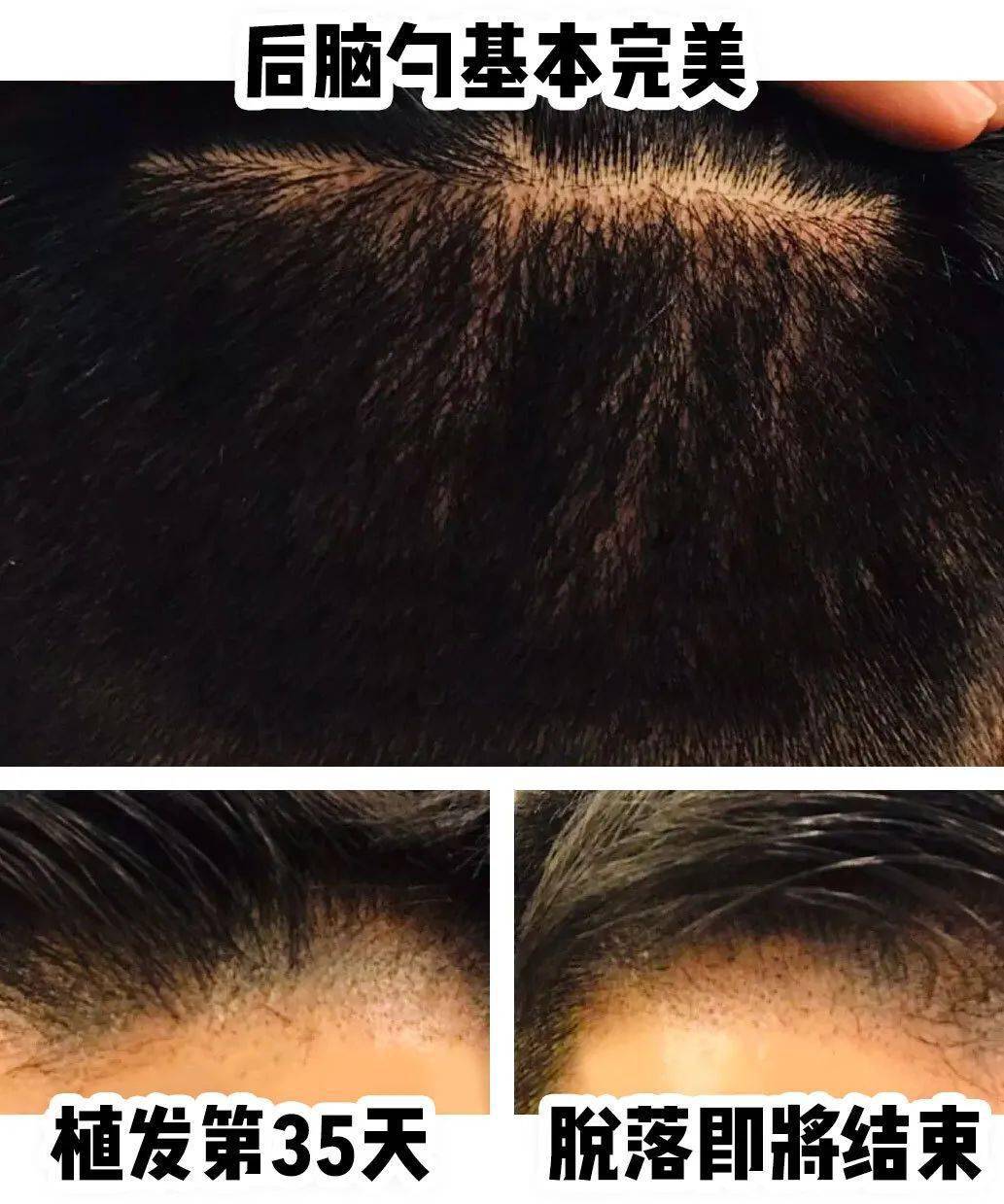 移植|国庆回去，我打算植发了！