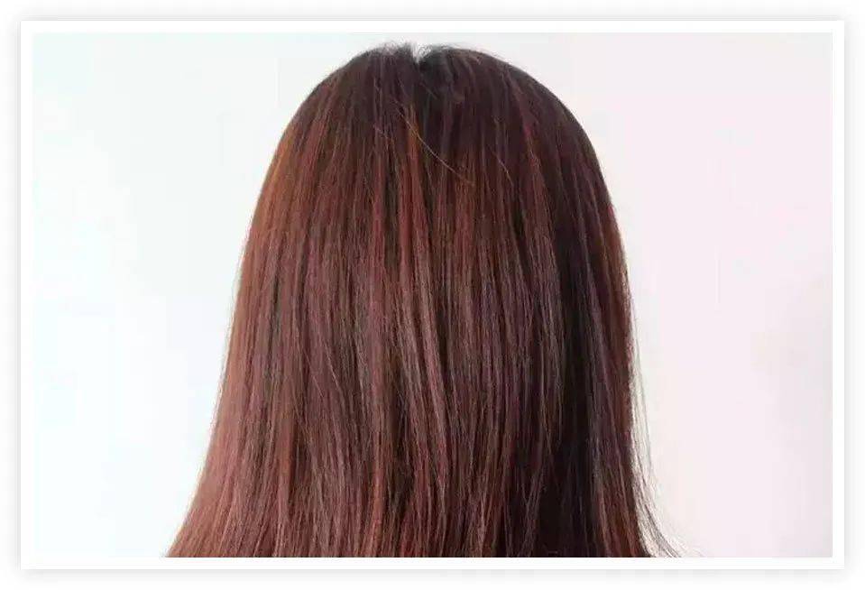 移植|国庆回去，我打算植发了！