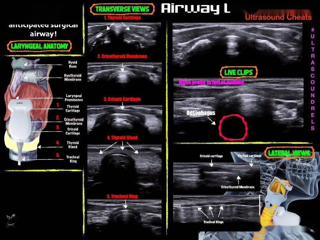 模拟|一图读懂气道超声