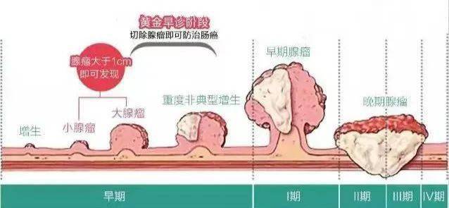 幽门螺旋杆菌感染:幽门螺旋杆菌能释放多种炎症介质及细胞因子