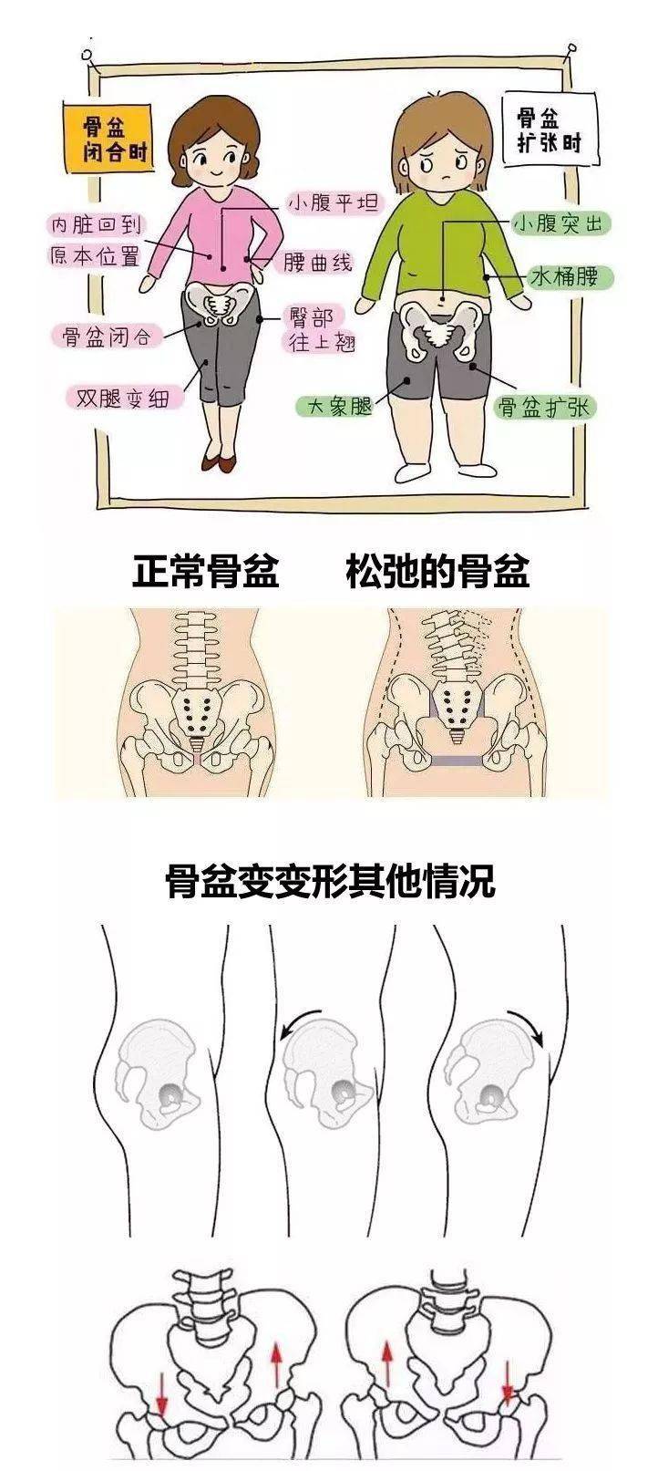 骨盆下口变宽,这会让臀部扁平;髋关节向内侧歪斜,臀部变宽;骨盆变得松