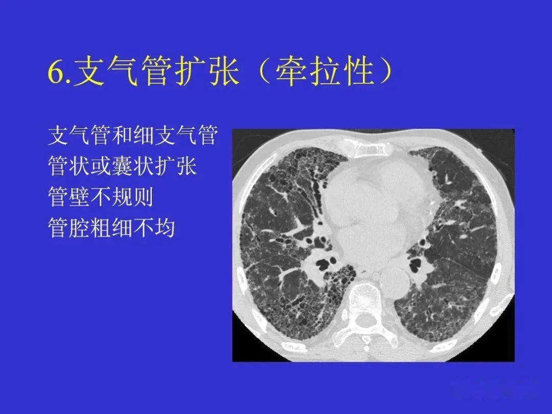 肺部间质性病变的ct诊断