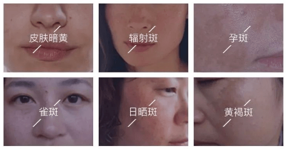 女人|如果你正长“色斑”,试试这个新方法,惊喜到让你尖叫!