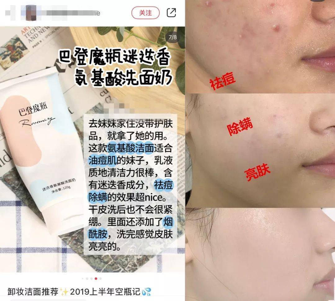 氨基酸|拒绝“螨虫脸”，5秒揉一揉，螨虫全出来了，痘痘黑头全没了！