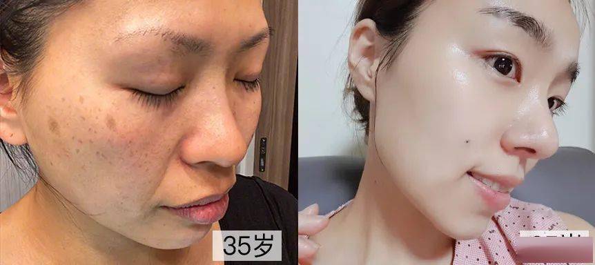 女人|如果你正长“色斑”,试试这个新方法,惊喜到让你尖叫!