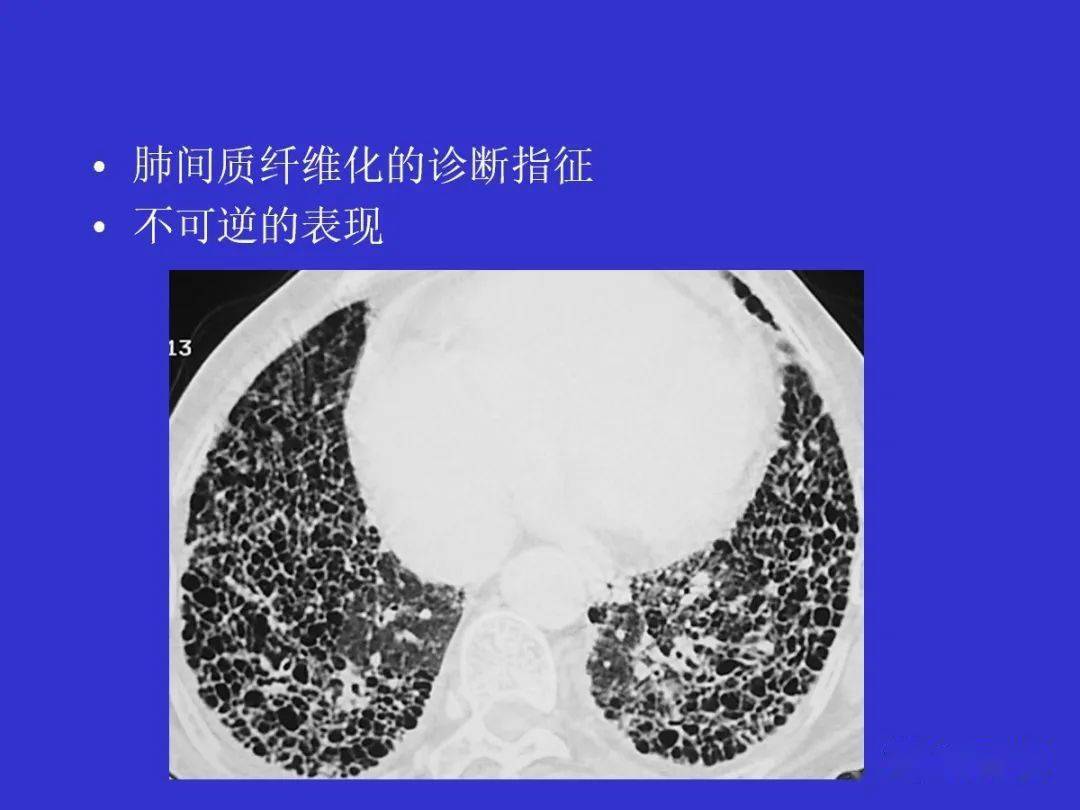 肺部间质性病变的ct诊断