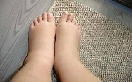 发展|得了肾病，离尿毒症还有多远？内科专家告诉你