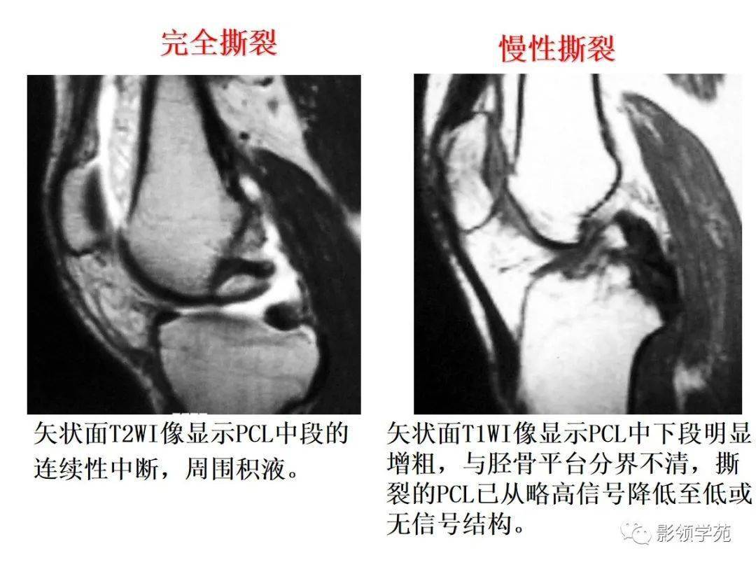 交叉韧带解剖及损伤的mri诊断