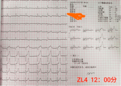 心电图呈「墓碑样」改变就是心肌梗死?错!