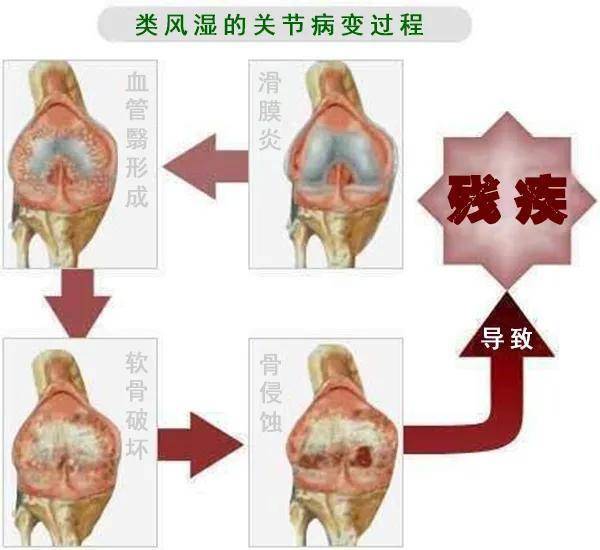 4,强直性脊柱炎